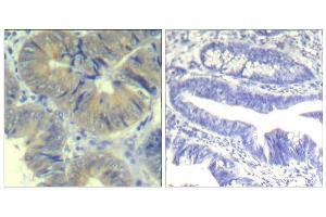 Immunohistochemical analysis of paraffin-embedded human colon carcinoma tissue using chk2 (phospho-Ser33) Antibody (E011527). (CHEK2 anticorps  (pSer33))