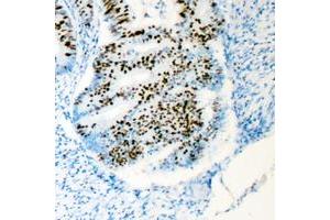 Immunohistochemical analysis of HCFC1 staining in human colon cancer formalin fixed paraffin embedded tissue section. (HCFC1 anticorps  (N-Term))