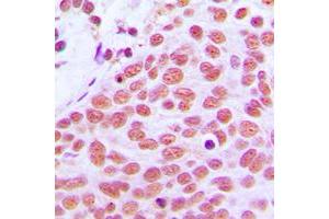 Immunohistochemical analysis of c-Jun staining in human breast cancer formalin fixed paraffin embedded tissue section. (C-JUN anticorps  (Center))