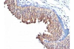 IHC testing of human bladder carcinoma with Keratin 10 antibody (clone LH2). (Keratin 10 anticorps)