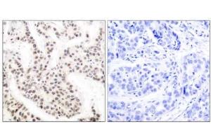 Immunohistochemical analysis of paraffin-embedded human breast carcinoma tissue using Elk-1 (phospho-Thr417) antibody (E011038). (ELK1 anticorps  (pThr417))