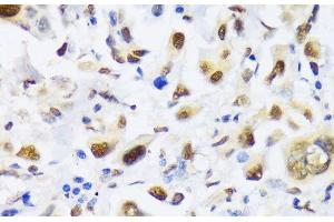 Immunohistochemistry of paraffin-embedded Human lung cancer using EP300 Polyclonal Antibody at dilution of 1:100 (40x lens). (p300 anticorps)
