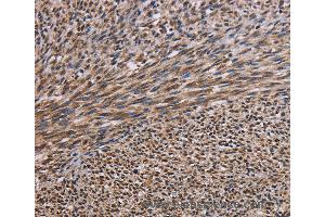 Immunohistochemistry of Human breast cancer using KIF2A Polyclonal Antibody at dilution of 1:30 (KIF2A anticorps)