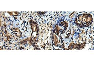 Immunohistochemistry of paraffin-embedded Human prost at e cancer tissue using TBCC Polyclonal Antibody at dilution of 1:80(x200) (TBCC anticorps)