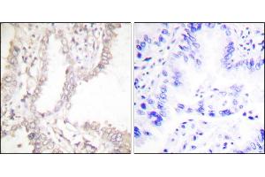 Immunohistochemical analysis of paraffin-embedded human lung carcinoma tissue using Prostate Apoptosis Response Protein-4 antibody. (PAWR anticorps)