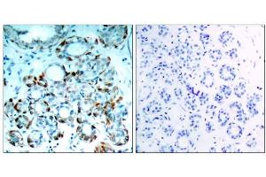 Immunohistochemical analysis of paraffin-embedded human breast carcinoma tissue, using BIM (phospho-Ser65) antibody (E011288). (BIM anticorps  (pSer65, pSer69))