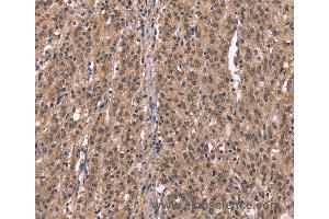 Immunohistochemistry of Human gastric cancer using HRH1 Polyclonal Antibody at dilution of 1:40 (HRH1 anticorps)