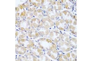 Immunohistochemistry of paraffin-embedded human stomach cancer using ANKRD52 antibody (ABIN5974842) at dilution of 1/100 (40x lens). (ANKRD52 anticorps)