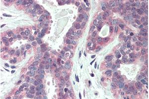 ABIN263217 (5µg/ml) staining of paraffin embedded Human Breast. (XBP1 anticorps  (Internal Region))