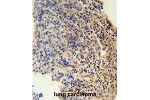 ZNF197 antibody (N-term) immunohistochemistry analysis in formalin fixed and paraffin embedded human lung carcinoma followed by peroxidase conjugation of the secondary antibody and DAB staining. (ZNF197 anticorps  (N-Term))