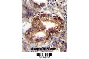 RAB3D Antibody immunohistochemistry analysis in formalin fixed and paraffin embedded human prostate carcinoma followed by peroxidase conjugation of the secondary antibody and DAB staining. (RAB3D anticorps  (C-Term))