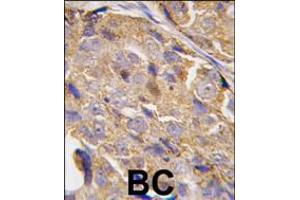 Formalin-fixed and paraffin-embedded human breast carcinoma tissue reacted with EIF4B-S422, which was peroxidase-conjugated to the secondary antibody, followed by DAB staining. (EIF4B anticorps  (AA 400-429))