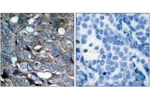 Immunohistochemistry analysis of paraffin-embedded human breast carcinoma, using ASK1 (Phospho-Ser83) Antibody. (ASK1 anticorps  (pSer83))