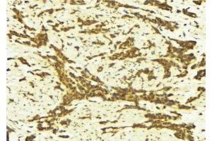 ABIN6269248 at 1/100 staining Human breast cancer tissue by IHC-P. (STAT5A anticorps  (C-Term))