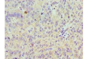 Immunohistochemistry of paraffin-embedded human liver cancer using ABIN7158607 at dilution of 1:100 (LYVE1 anticorps  (AA 20-238))