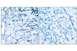 Immunohistochemical analysis of paraffin-embedded human breast carcinoma tissue using CDC2(Phospho-Thr161) Antibody(left) or the same antibody preincubated with blocking peptide(right). (CDK1 anticorps  (pThr161))