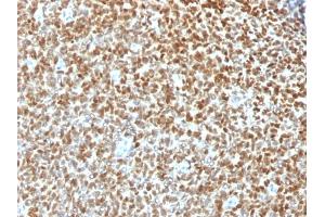 Formalin-fixed, paraffin-embedded human Ewing's Sarcoma stained with NKX2. (Recombinant Nkx2-2 anticorps)