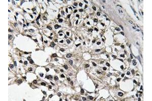 Immunohistochemistry analyzes of IRS-1 antibody in paraffin-embedded human breast carcinoma tissue. (IRS1 anticorps)
