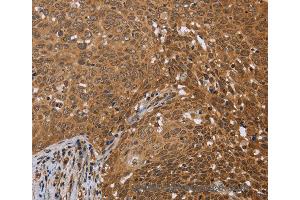 Immunohistochemistry of Human cervical cancer using FKBP8 Polyclonal Antibody at dilution of 1:50 (FKBP8 anticorps)