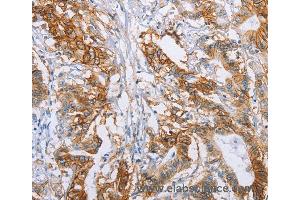 Immunohistochemistry of Human liver cancer using CA9 Polyclonal Antibody at dilution of 1:50 (CA9 anticorps)