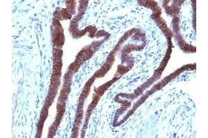 Formalin-fixed, paraffin-embedded human ovarian carcinoma stained with EpCAM antibody (EGP40/1110). (EpCAM anticorps  (Cytoplasmic Domain))