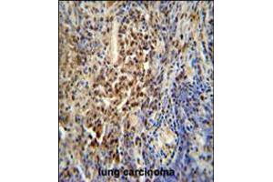 PUS3 antibody immunohistochemistry analysis in formalin fixed and paraffin embedded human lung carcinoma followed by peroxidase conjugation of the secondary antibody and DAB staining. (PUS3 anticorps  (N-Term))