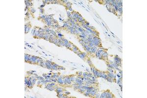 Immunohistochemistry of paraffin-embedded human colon carcinoma using CYP1A1 antibody. (CYP1A1 anticorps)