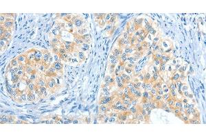Immunohistochemistry of paraffin-embedded Human cervical cancer tissue using COL4A2 Polyclonal Antibody at dilution 1:70 (COL4a2 anticorps)