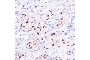 Immunohistochemistry of paraffin-embedded human breast cancer using [KO Validated] CDKN1A/p21CIP1 Rabbit pAb (ABIN1679159, ABIN1679158, ABIN3016472 and ABIN6219758) at dilution of 1:100 (40x lens). (p21 anticorps  (AA 1-164))
