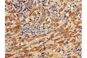 Immunohistochemistry of paraffin-embedded human liver cancer using ABIN7156663 at dilution of 1:100 (IFIT1 anticorps  (AA 1-181))