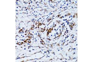 Immunohistochemistry of paraffin-embedded human uterine cancer using RARS antibody (ABIN5973728) at dilution of 1/100 (40x lens). (RARS anticorps)