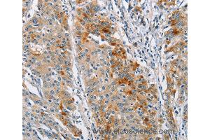 Immunohistochemistry of Human gastric cancer using BCL10 Polyclonal Antibody at dilution of 1:40 (BCL10 anticorps)