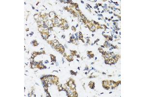 Immunohistochemistry of paraffin-embedded human breast cancer using DHRS2 antibody (ABIN5973846) at dilution of 1/100 (40x lens). (DHRS2 anticorps)