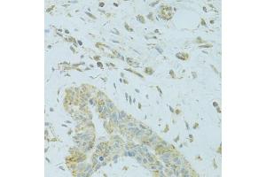 Immunohistochemistry of paraffin-embedded human breast cancer using MTFP1 antibody (ABIN5975088) at dilution of 1/100 (40x lens). (Mtfp1 anticorps)