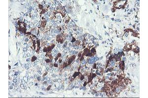 Immunohistochemical staining of paraffin-embedded Adenocarcinoma of Human breast tissue using anti-SERPINB2 mouse monoclonal antibody. (SERPINB2 anticorps)