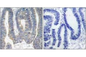 Immunohistochemistry analysis of paraffin-embedded human colon carcinoma, using PKR (Ab-451) Antibody. (EIF2AK2 anticorps  (AA 418-467))
