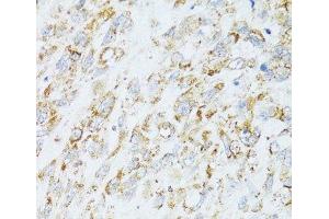 Immunohistochemistry of paraffin-embedded Human lung cancer using EGFR Polyclonal Antibody at dilution of 1:100 (40x lens). (EGFR anticorps)