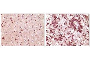 Immunohistochemical analysis of paraffin-embedded human brain tumor tissue, showing nuclear and cytoplasmic localization using ELK1 mouse mAb with DAB staining. (ELK1 anticorps)