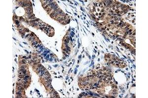 Immunohistochemical staining of paraffin-embedded Adenocarcinoma of colon tissue using anti-PSMC3 mouse monoclonal antibody. (PSMC3 anticorps)