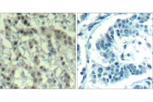 Immunohistochemical analysis of paraffin-embedded human breast carcinoma tissue using AuroraA (phospho-Thr288) Antibody (E011519). (Aurora A anticorps  (pThr288))