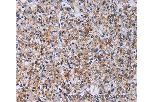 Immunohistochemistry of Human prostate cancer using CA4 Polyclonal Antibody at dilution of 1:30 (CA4 anticorps)