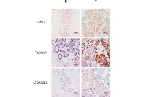 Representative IHC of non-neoplastic (N) and triple-negative breast cancer (T) tissues of VWCE, TSPAN9 and ADAM12 proteins. (ADAM12 anticorps  (AA 589-738))