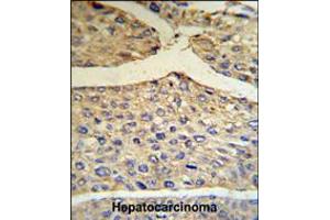 BF Antibody IHC analysis in formalin fixed and paraffin embedded human hepatocarcinoma tissue followed by peroxidase conjugation of the secondary antibody and DAB staining. (Complement Factor B anticorps  (AA 395-422))