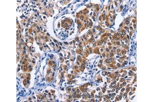 Immunohistochemistry of Human breast cancer using MYH1 Polyclonal Antibody at dilution of 1:40 (MYH1 anticorps)