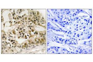 Immunohistochemistry analysis of paraffin-embedded human breast carcinoma tissue using Myb (Phospho-Ser532) antibody. (MYB anticorps  (pSer532))