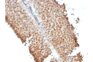 IHC testing of bladder carcinoma stained with Estrogen Receptor beta antibody (ERb455). (ESR2 anticorps  (C-Term))