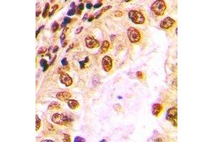 Immunohistochemical analysis of Nibrin staining in human lung cancer formalin fixed paraffin embedded tissue section. (Nibrin anticorps)