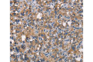 Immunohistochemistry (IHC) image for anti-Carcinoembryonic Antigen-Related Cell Adhesion Molecule 6 (CEACAM6) antibody (ABIN2432097) (CEACAM6 anticorps)
