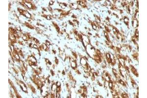 Formalin-fixed, paraffin-embedded human rhabdomyosarcoma stained with pan Muscle Actin antibody (MSA/953) (Pan Muscle Actin anticorps)