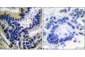 Immunohistochemistry analysis of paraffin-embedded human lung carcinoma, using Caspase 3 (Cleaved-Asp175) Antibody. (Caspase 3 anticorps  (Cleaved-Asp175))